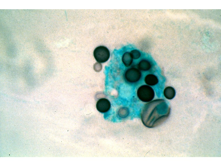Cryptococcus neoformans gram stain